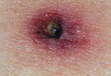 Проф. Ива Христова: Има много случаи на ухапани от кърлежи и на лаймска болест