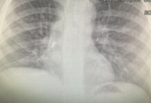 Дете глътна зъба си, разви инфекция и за малко да се задуши, лекари в Бургас го спасиха