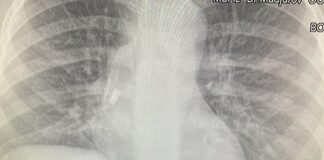 Дете глътна зъба си, разви инфекция и за малко да се задуши, лекари в Бургас го спасиха