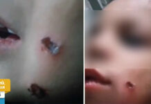 Шестгодишно момче горено с цигара по лицето