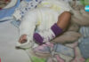 Приеха в болница новородено с жълтеница, изписаха го със счупен крак