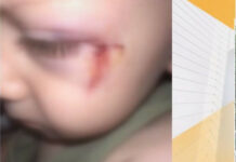 2-годишно дете е с подуто око и шевове на лицето след инцидент в детски център