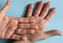 Проф. Ива Христова: Няма риск от епидемия от маймунска шарка