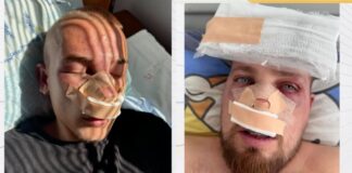 Двама братя са със счупени носове и зъби след побой в дискотека