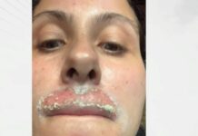 Жена твърди, че е обезобразена след дерматологична процедура с лазер