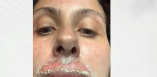 Жена твърди, че е обезобразена след дерматологична процедура с лазер