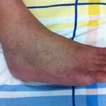 Първи случай на треска чикунгуня у нас