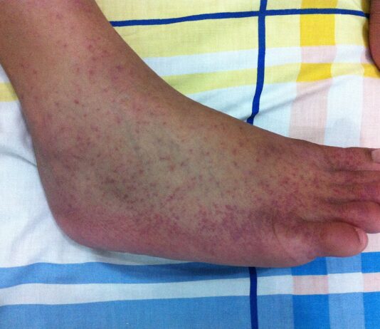 Първи случай на треска чикунгуня у нас