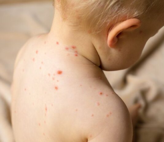 Огнище на морбили във Врачанско