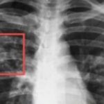 До 27 март в София ще има безплатни консултации за туберкулоза