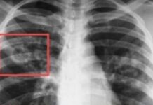 До 27 март в София ще има безплатни консултации за туберкулоза