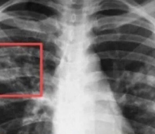 До 27 март в София ще има безплатни консултации за туберкулоза